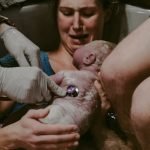 Accouchement par césarienne